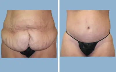 Before and After